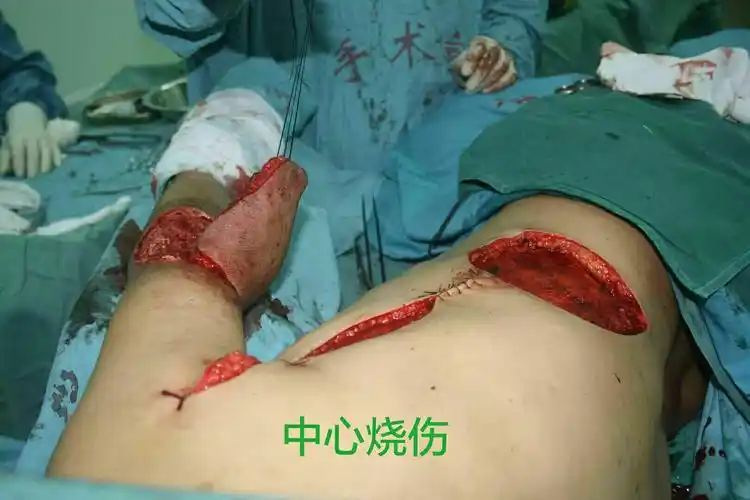 背阔肌岛状皮瓣治疗右肘部皮肤癌——青岛市中心医院烧伤整形科慢性