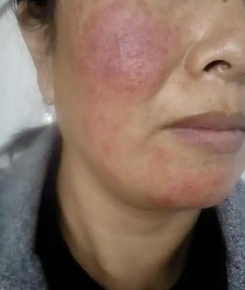 皮肤屏障受损为什么夏天更严重?皮肤屏障是什么?