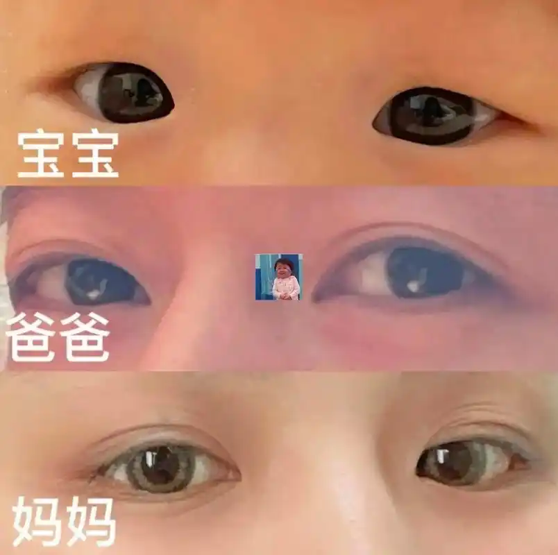 单双眼皮遗传规律  单眼皮:单眼皮是指眼睑没有明显的眼皮褶皱,通常较