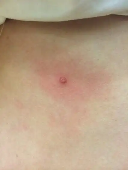 腰上面长个肉疙瘩,不疼不痒!