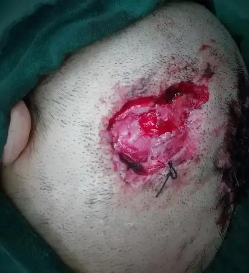 创面部位决定皮瓣选择