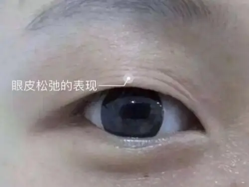 如何判断的眼皮是否松弛