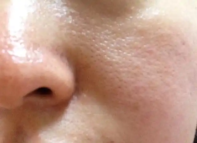 为何皮肤出油会毛孔粗大?如何改善毛孔粗大问题?