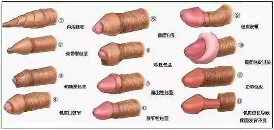 什么是包茎?预约流程:电话或门诊确定手术日期----手术前2天在