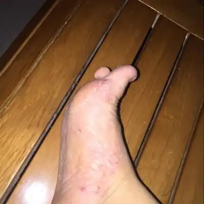 我在怀孕前脚掌就有脱皮,痒,了就起小水泡,怀孕后期好像更严重,这样