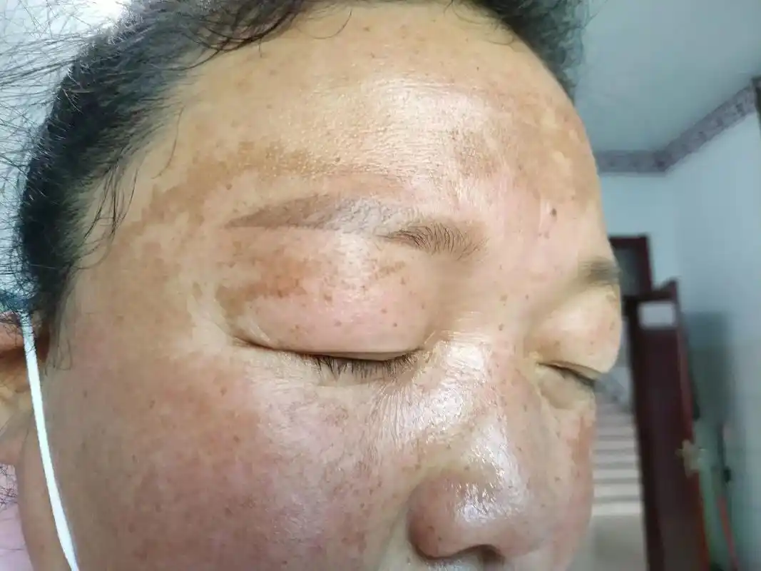 皮肤科张赞杰医生治疗黄褐斑和小儿面部过敏 - 抖音