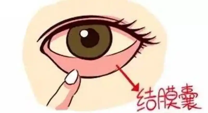 药水不是滴在眼球上,也不是滴在眼角上,而是应该滴在在结膜囊内哦!