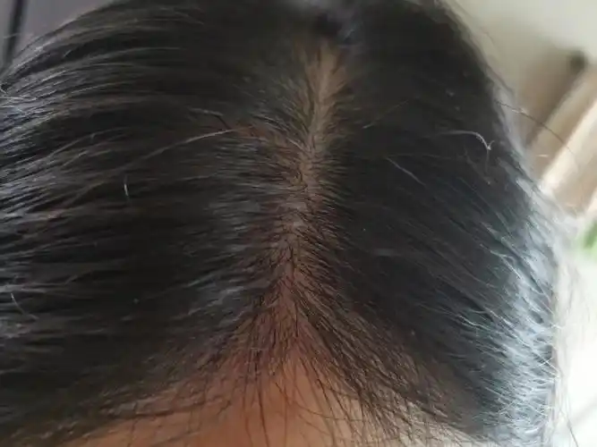 20220802头发更新毛囊里长出2根头发了
