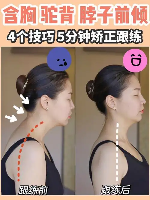含胸驼背脖子前倾怎么矫正每天5分钟4步