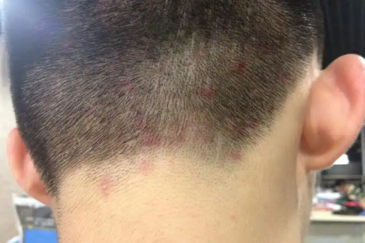 后脑勺脂溢性皮炎早期可能只会表现为轻度潮红斑片,上面覆盖有灰白色