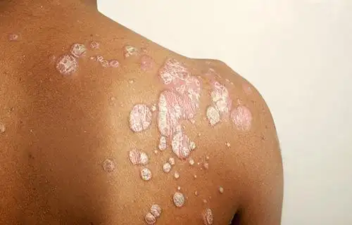 由致病真菌寄生在人体的光滑皮肤上(除手,足,毛发,甲板以及股阴部以外