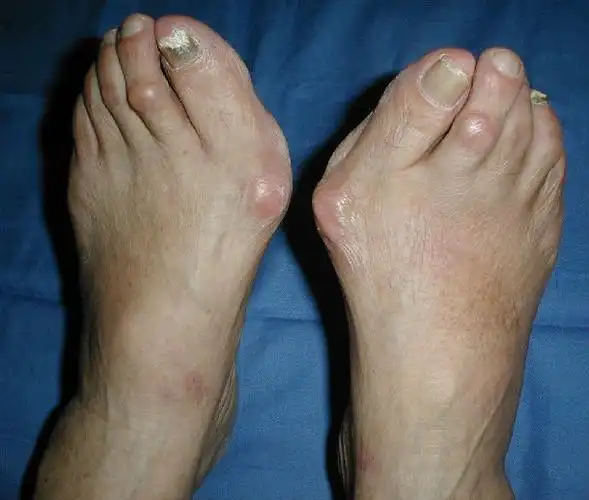 足趾人工关节置换术治疗拇外翻畸形 - 好大夫在线