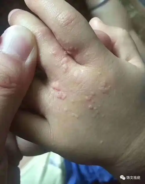 孩子感染病毒疣的原因究竟有哪些?