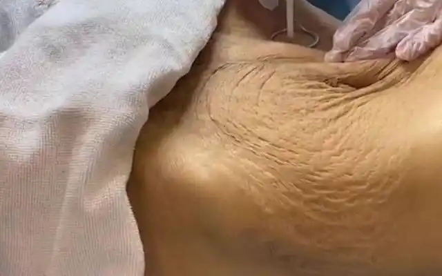 产后皮肤松弛怎样才能收紧皮肤