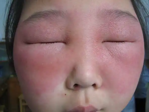 怎么做预防面部有化妆品皮炎_化妆品皮炎_北京京城皮肤病医院(北京