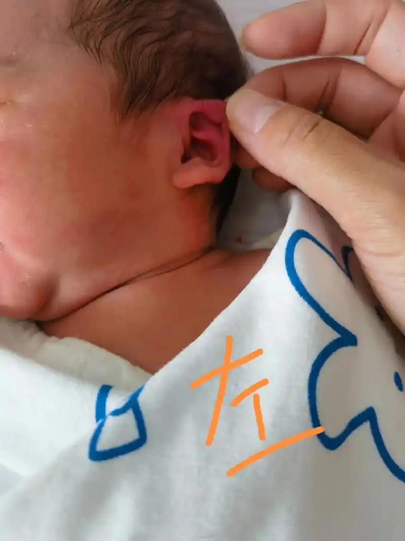 人类幼崽 #月子里的宝宝 刚出生第二天,医生说我们左耳朵粘 - 抖音