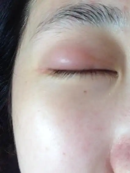 我的眼睛疼啦好多天,今早起床发现在眼睛起个包,在上眼皮眼尾,眼球转