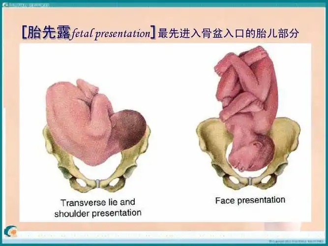 [胎先露fetal presentation]最先进入骨盆入口的胎儿部分