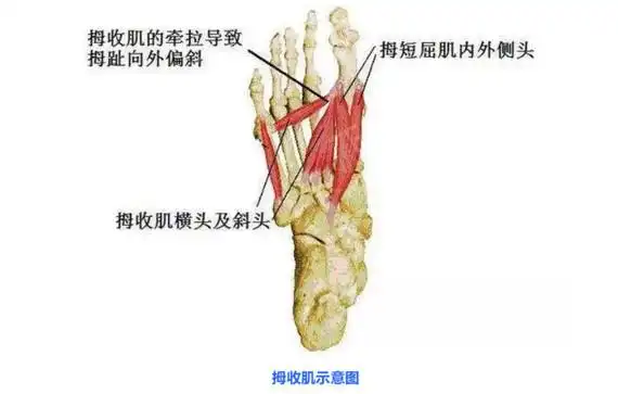 "大脚骨"在医学上被叫为拇外翻,它主要表现为拇趾向_圈子-新氧美容