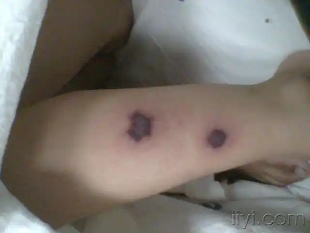 提供一以皮肤为主要症状的脓毒血症已请皮肤科血液科感染科会诊0