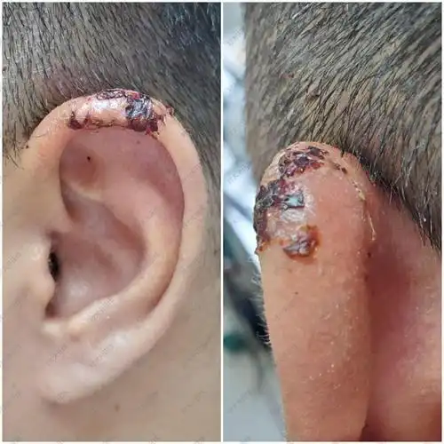 耳廓小肿物1_体表肿瘤 - 好大夫在线