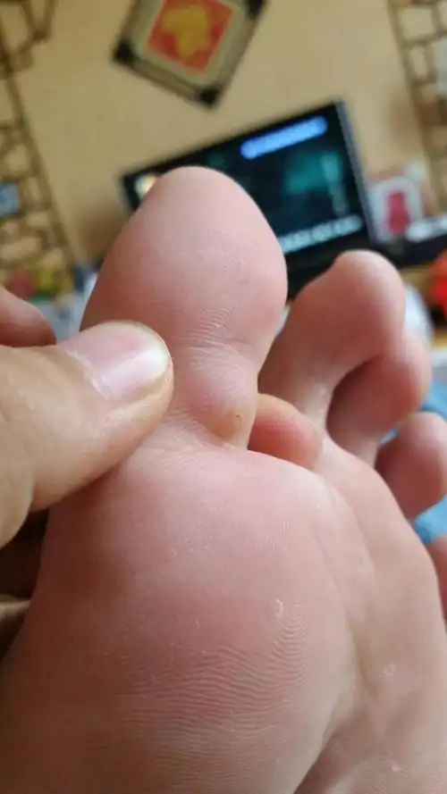 鸡眼图片初期症状 鸡眼早期症状图片