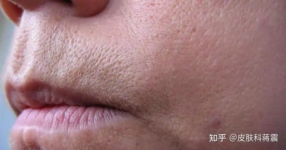 毛孔粗大有哪些类型该如何治疗