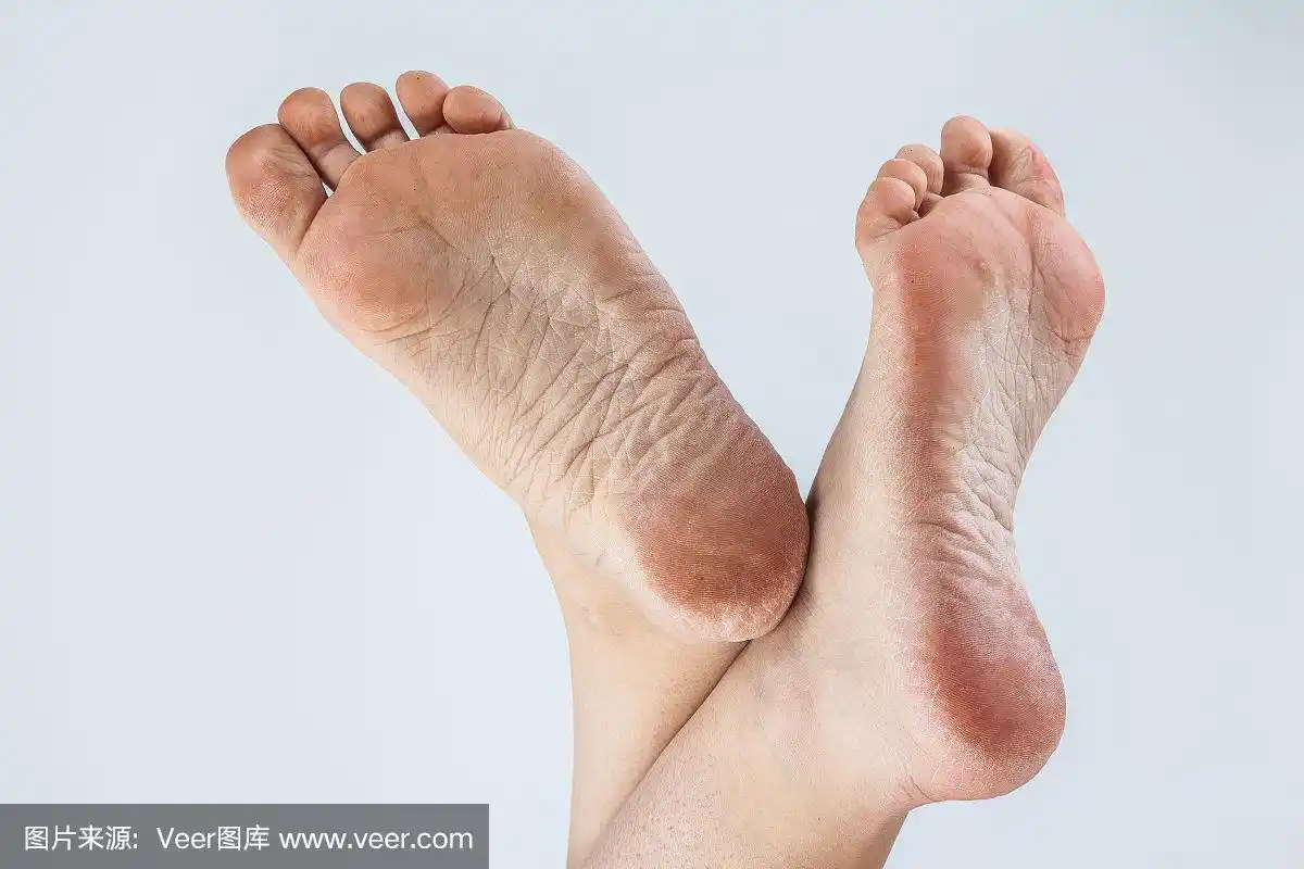 足,干旱,皮肤,女性,脚掌