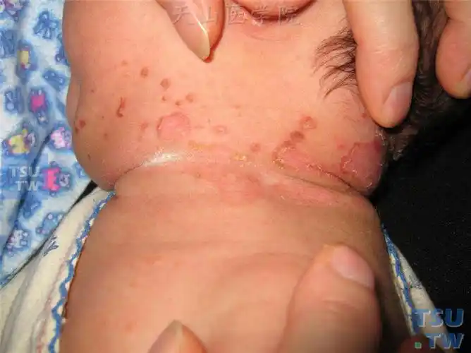 【附图】 肠病性肢端皮炎的症状表现 _皮肤病诊断图谱 | 天山医学院