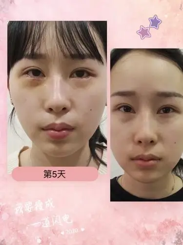 下至术 开外眼角术后5天拆线