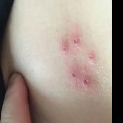 腰上起了痘痘,开始没在意就两个也不痒,三四天后就这样了,是湿疹吗?