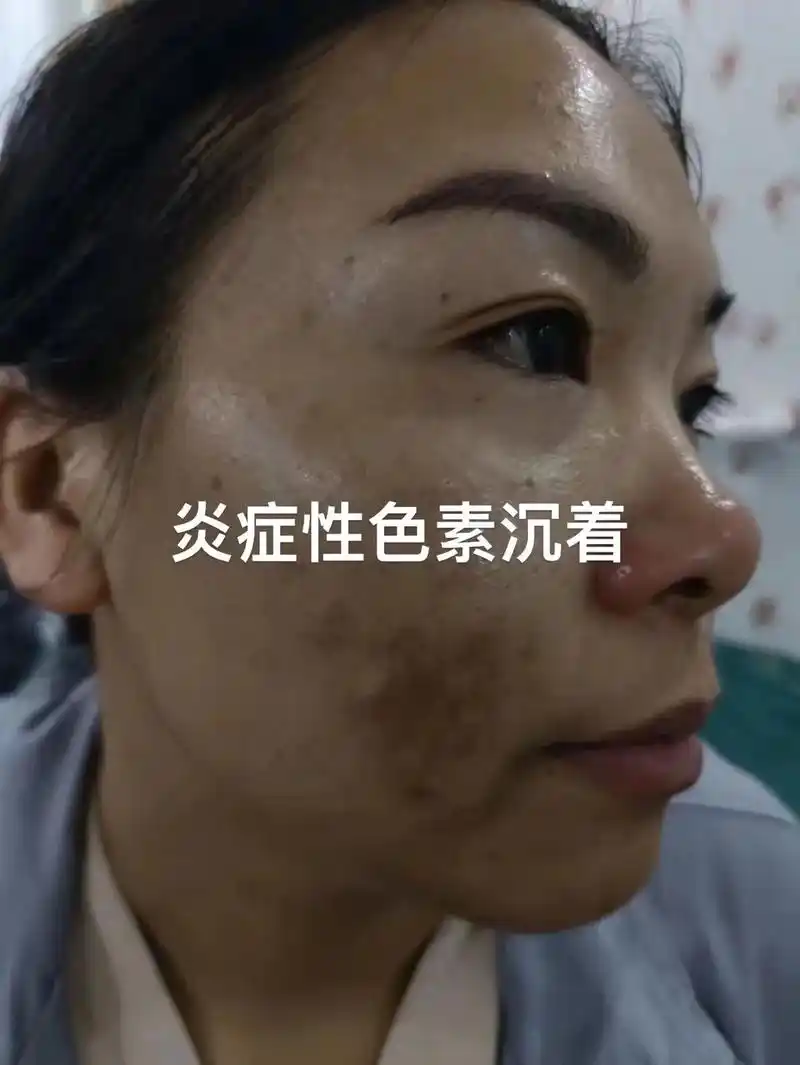 痘痘也许不可怕 色素沉着可不斑斑好受#问题性皮肤管理 #同城 - 抖音