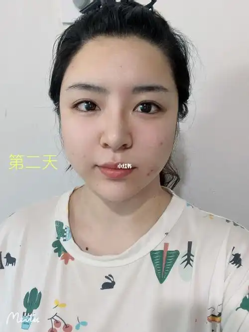 拔智齿第二天脸有点凹