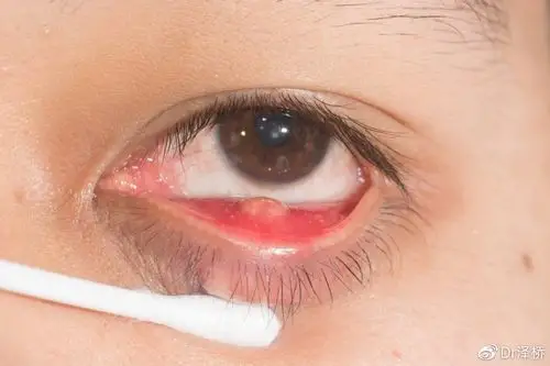 麦粒肿不要急下面方法帮到你