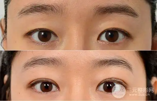 埋线双眼皮对比图