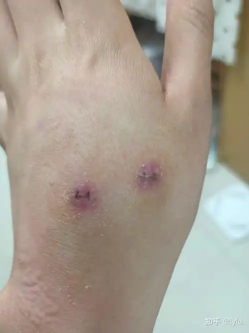 手术切痣|拆线后第一天记录 - 知乎