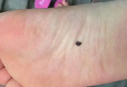 脚底长痣是富贵命吗,脚板有痣解析