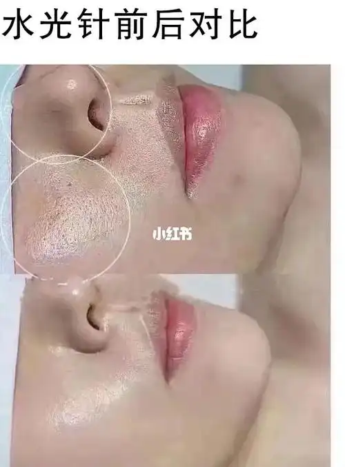 水光针前后对比