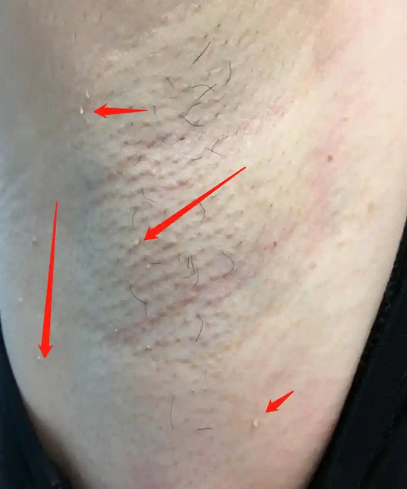 【hpv小知识】腋下多发性的丝状疣,也是一种hpv病毒感染.