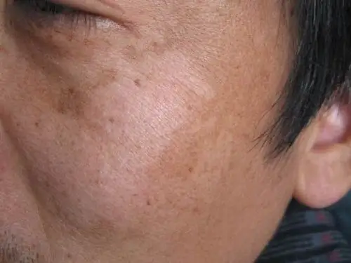 怎么调理面部黄褐斑_黄褐斑_北京京城皮肤病医院(北京医保定点机构)