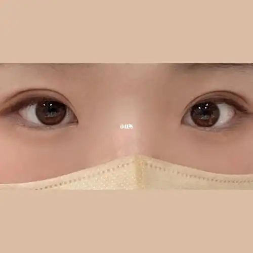 肿眼泡埋线双眼皮两个月啦