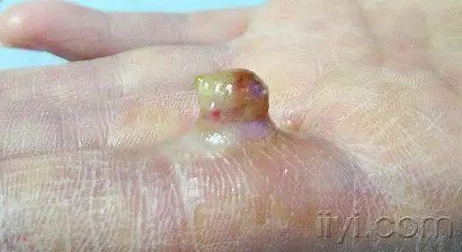 典型图片--化脓性肉芽肿 - 皮肤及性传播疾病讨论版 - 爱爱医医学论坛