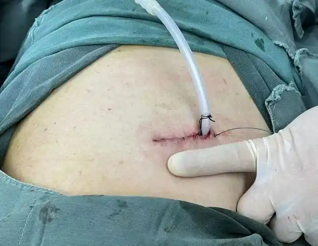 镜切口微创手术-三孔胸腔镜切口开胸手术切口开胸手术切口下面看图