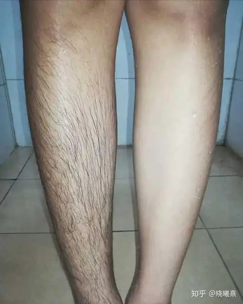 男生穿短裤要不要刮腿毛(腿毛重)?