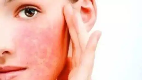 激素脸,敏感肌,傻傻分不清楚?怎么拯救你的脸?