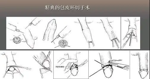 包皮环切术后图片