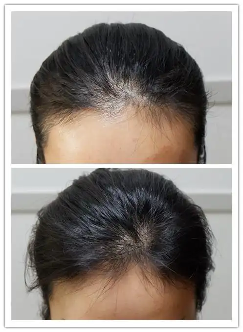 宝鸡mini生发发际线前后对比图