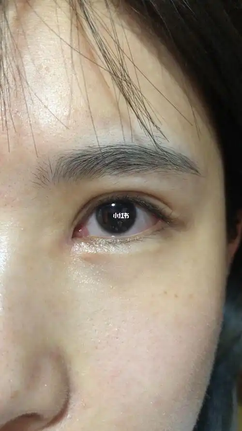 包眼角满月_内眼角_内眼角修复_美妆_医美整形