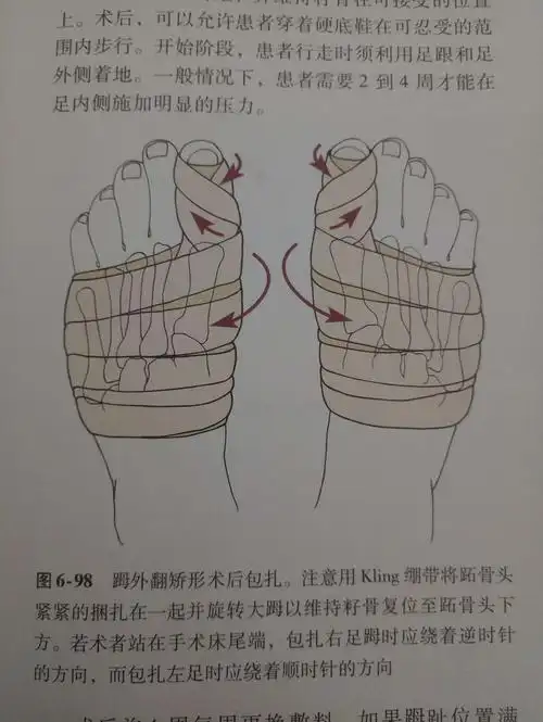 拇外翻的力学机制及纠正