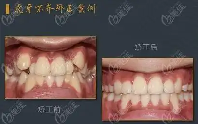 复杂虎牙病例矫正对比图